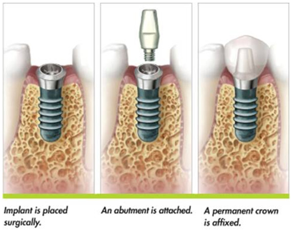 dental-implant-in-ahmedabad